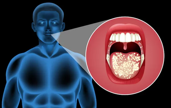 Mouth Cancer