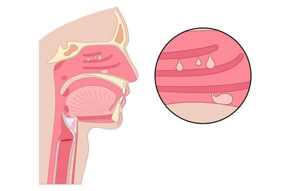 Nose or Paranasal Sinus Tumors